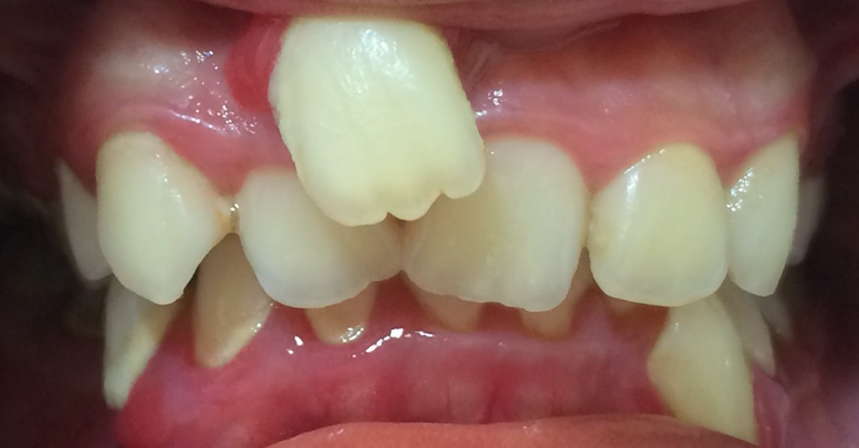 Crowding Severe with Blocked Tooth BEFORE